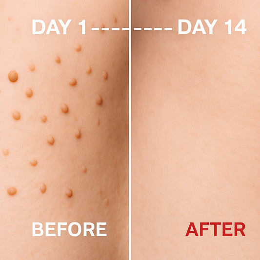 Warts Remover Original Cream – Fast & Gentle Wart Removal Treatment