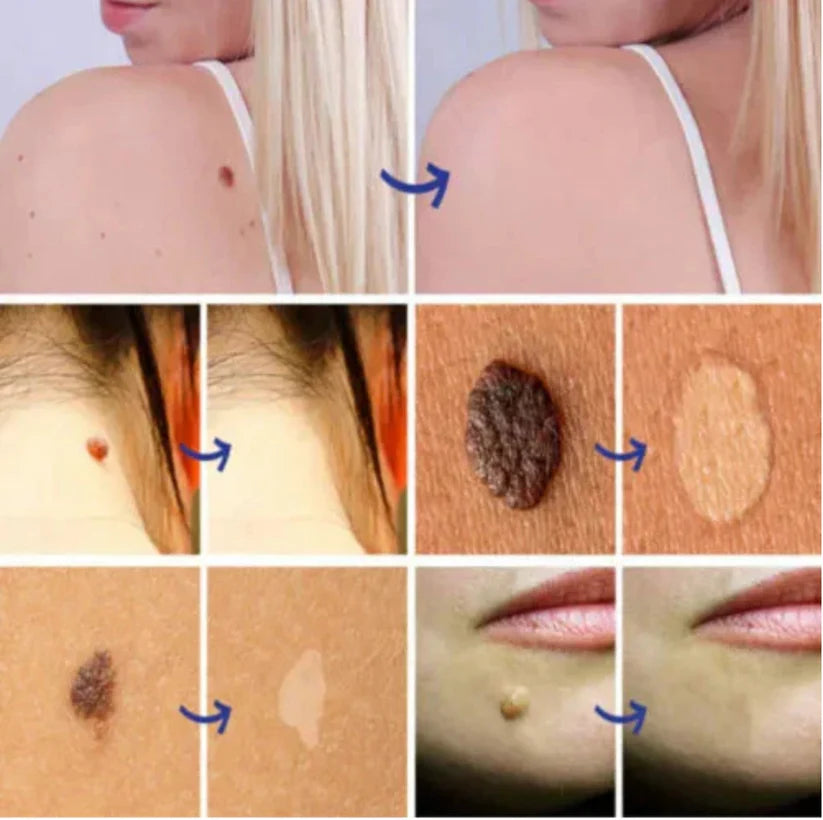 Warts Remover Original Cream – Fast & Gentle Wart Removal Treatment