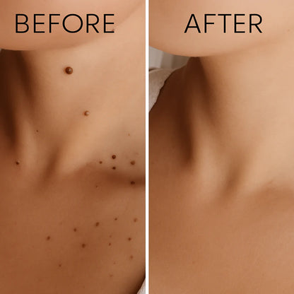 Warts Remover Original Cream – Fast & Gentle Wart Removal Treatment